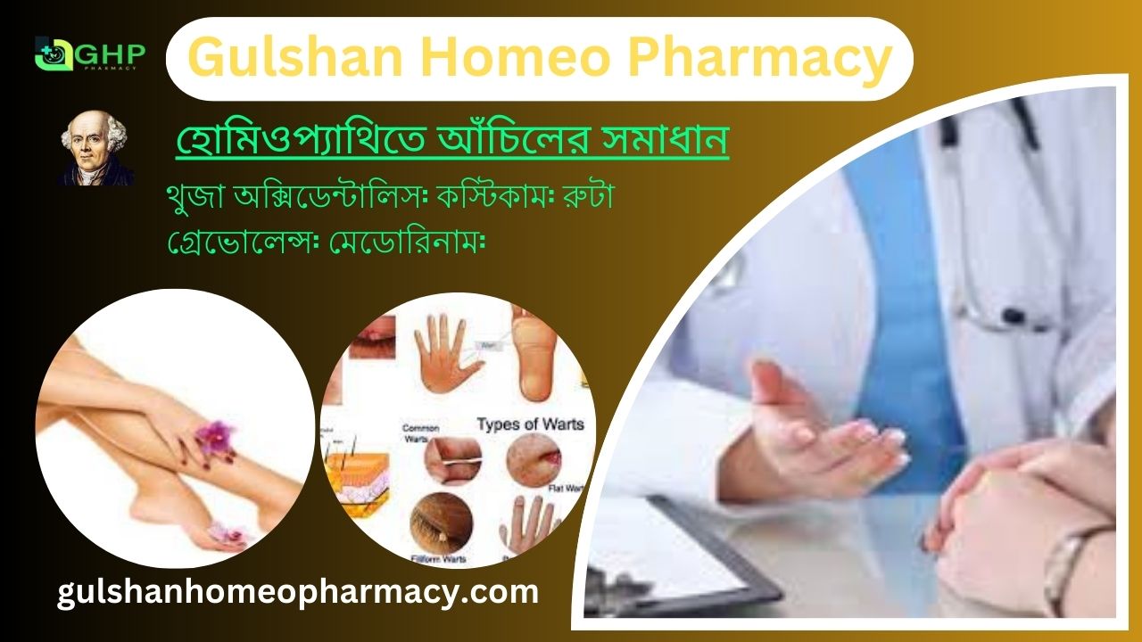 আঁচিল কী? আঁচিল হওয়ার কারণ, আঁচিলের ধরন, আঁচিলের উপসর্গ, হোমিওপ্যাথিতে আঁচিলের সমাধান