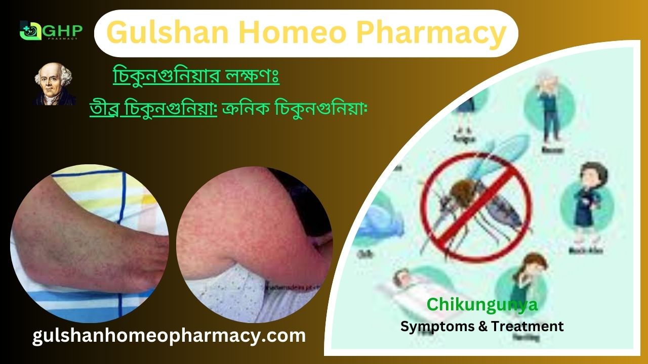 চিকুনগুনিয়া কি?, চিকুনগুনিয়া হওয়ার কারণ, চিকুনগুনিয়ার প্রকার, চিকুনগুনিয়ার লক্ষণ, চিকুনগুনিয়া হোমিওপ্যাথি দ্বারা সমাধান