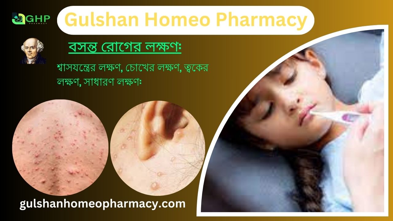 বসন্ত রোগ কি? বসন্ত রোগের ধরন, বসন্ত রোগের উপসর্গ, হোমিওপ্যাথি দ্বারা বসন্ত রোগের সমাধান