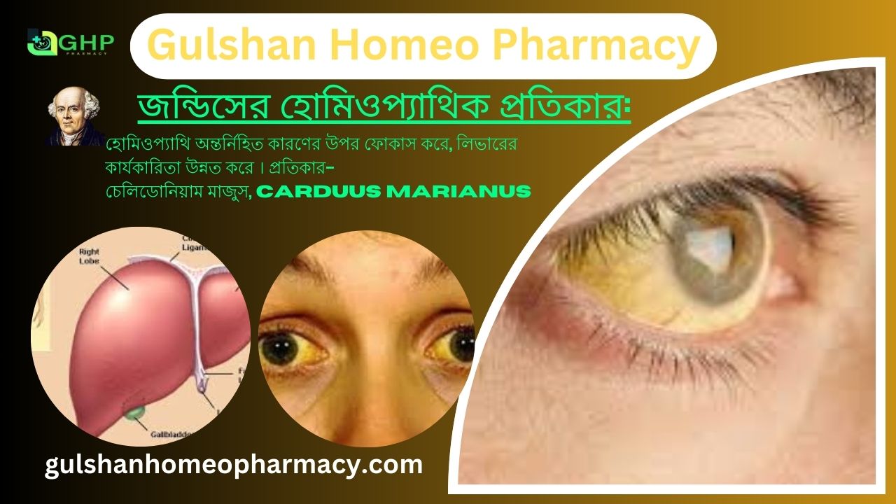 জন্ডিস কি? জন্ডিসের ধরন, জন্ডিসের লক্ষণ, হোমিওপ্যাথি দ্বারা জন্ডিস সমাধান