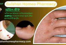 আঁচিল কী? আঁচিল হওয়ার কারণ, আঁচিলের ধরন, আঁচিলের উপসর্গ, হোমিওপ্যাথিতে আঁচিলের সমাধান