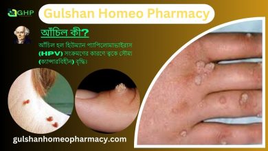 আঁচিল কী? আঁচিল হওয়ার কারণ, আঁচিলের ধরন, আঁচিলের উপসর্গ, হোমিওপ্যাথিতে আঁচিলের সমাধান