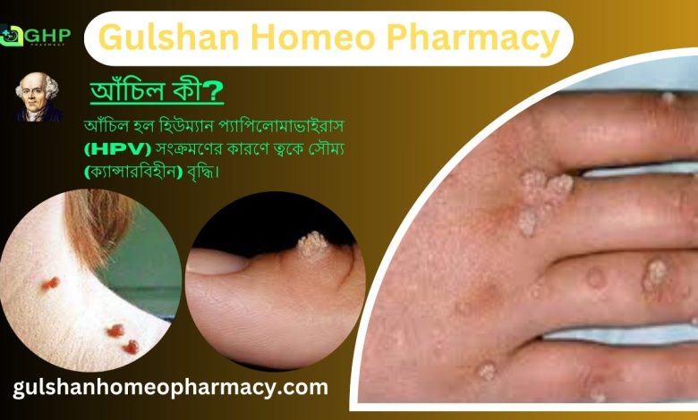 আঁচিল কী? আঁচিল হওয়ার কারণ, আঁচিলের ধরন, আঁচিলের উপসর্গ, হোমিওপ্যাথিতে আঁচিলের সমাধান