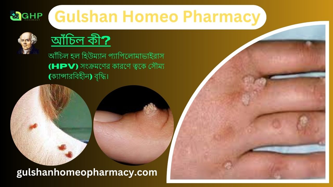 আঁচিল কী? আঁচিল হওয়ার কারণ, আঁচিলের ধরন, আঁচিলের উপসর্গ, হোমিওপ্যাথিতে আঁচিলের সমাধান