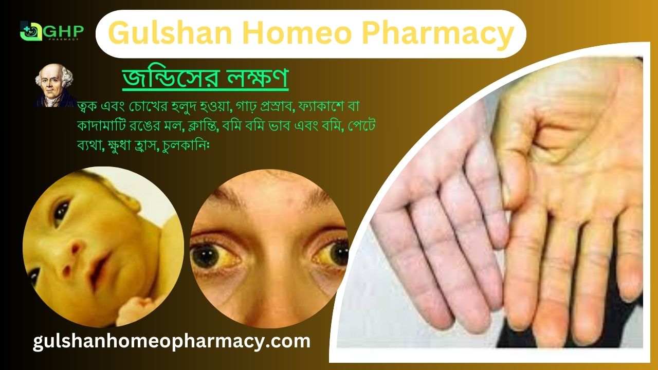 জন্ডিস কি? জন্ডিসের ধরন, জন্ডিসের লক্ষণ, হোমিওপ্যাথি দ্বারা জন্ডিস সমাধান
