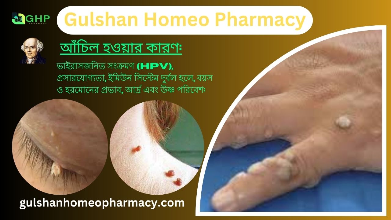 আঁচিল কী? আঁচিল হওয়ার কারণ, আঁচিলের ধরন, আঁচিলের উপসর্গ, হোমিওপ্যাথিতে আঁচিলের সমাধান