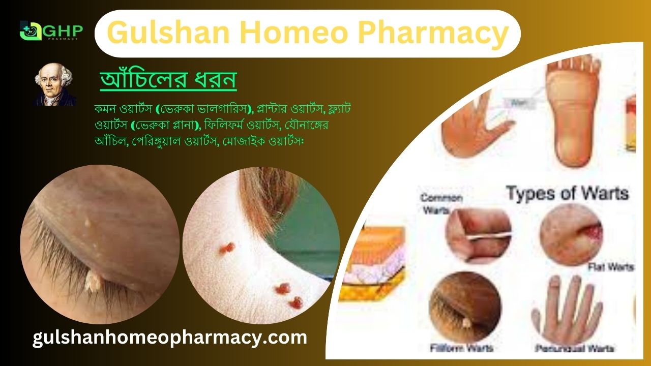 আঁচিল কী? আঁচিল হওয়ার কারণ, আঁচিলের ধরন, আঁচিলের উপসর্গ, হোমিওপ্যাথিতে আঁচিলের সমাধান