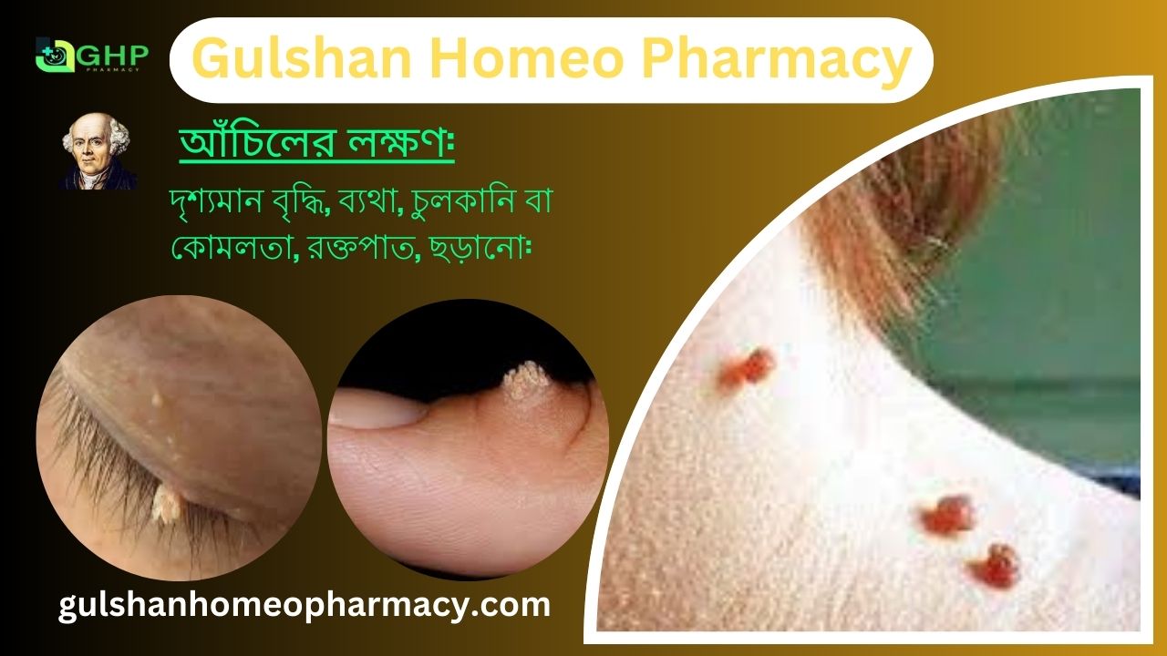আঁচিল কী? আঁচিল হওয়ার কারণ, আঁচিলের ধরন, আঁচিলের উপসর্গ, হোমিওপ্যাথিতে আঁচিলের সমাধান