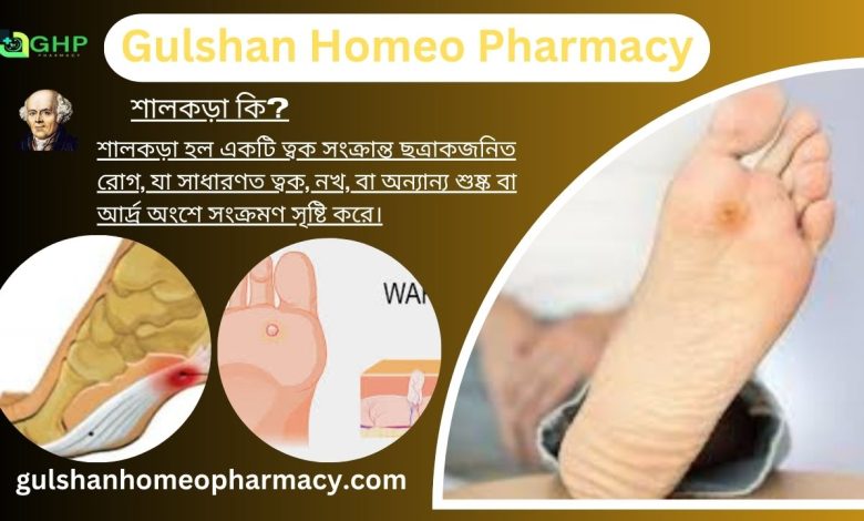 শালকড়া কি?, শালকড়া হওয়ার কারণ, শালকড়ার ধরন,শালকড়ার লক্ষণ, হোমিওপ্যাথিতে শালকড়ার চিকিৎসা