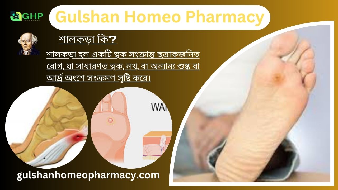 শালকড়া কি?, শালকড়া হওয়ার কারণ, শালকড়ার ধরন,শালকড়ার লক্ষণ, হোমিওপ্যাথিতে শালকড়ার চিকিৎসা