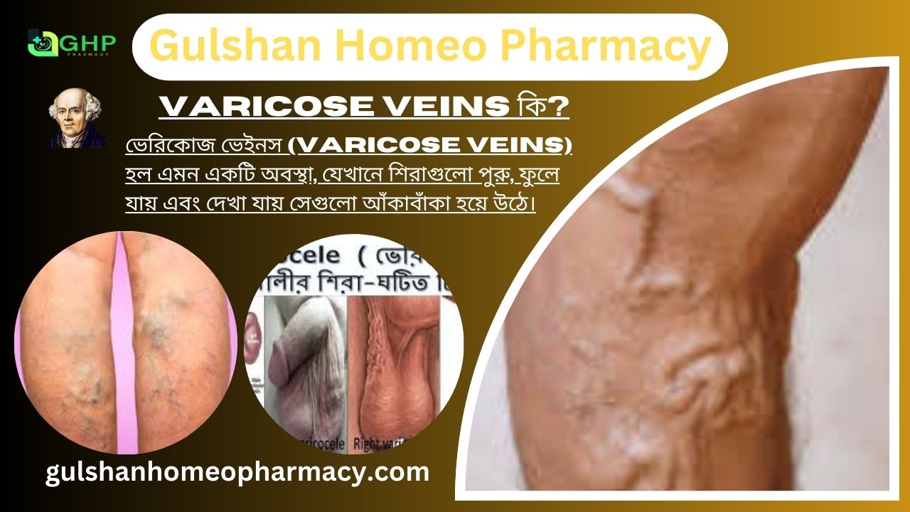 Varicose veins কি?, Varicose veins হওয়ার কারণ, Varicose veins এর ধরণ, Varicose veins এর লক্ষণ, Varicose veins এর হোমিওপ্যাথি চিকিৎসা