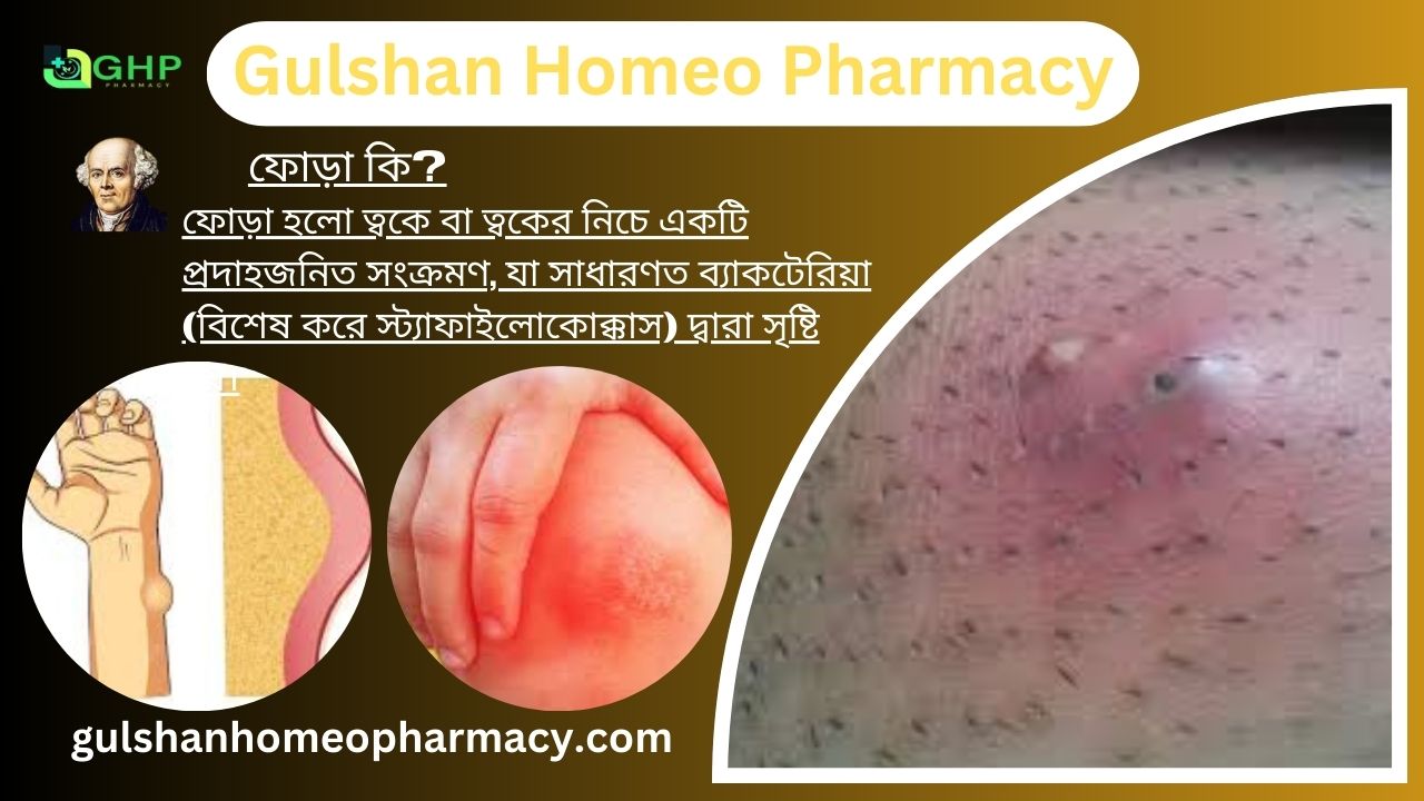 ফোড়া কি?, ফোড়া হওয়ার কারণ, ফোড়ার ধরন, ফোড়ার লক্ষণ, হোমিওপ্যাথিতে ফোড়ার চিকিৎসা