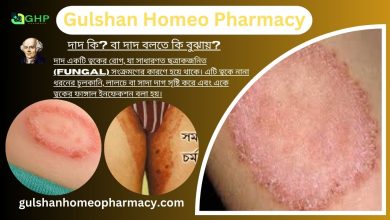 দাদ কি?, দাদ হওয়ার কারণ, দাদের ধরন, দাদের লক্ষণ, দাদের হোমিওপ্যাথিক চিকিৎসা