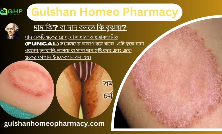 দাদ কি?, দাদ হওয়ার কারণ, দাদের ধরন, দাদের লক্ষণ, দাদের হোমিওপ্যাথিক চিকিৎসা